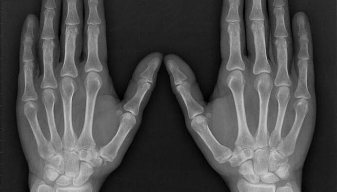 Radiografía para diagnosticar artrite e artrose