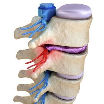 Un nervio pinchado na columna está acompañado de dor punzante