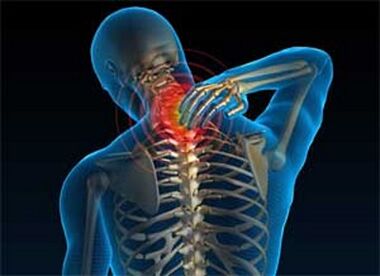 A dor no pescozo é un síntoma común da osteocondrose
