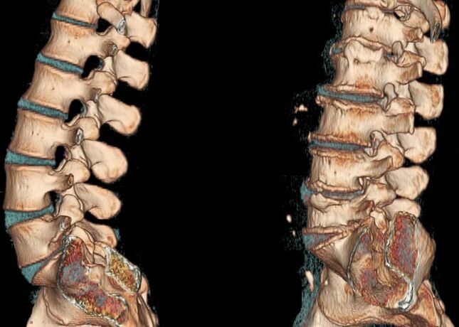Osteocondrose da rexión lumbar