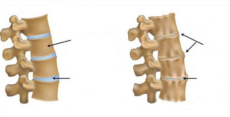 Síndrome isquémico para osteocondrose