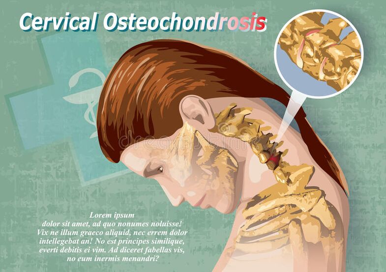 A osteocondrose cervical é unha enfermidade do tecido da cartilaxe