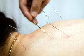 Acupuntura para osteocondrose