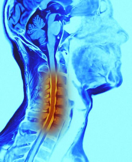 Columna cervical e osteocondrose