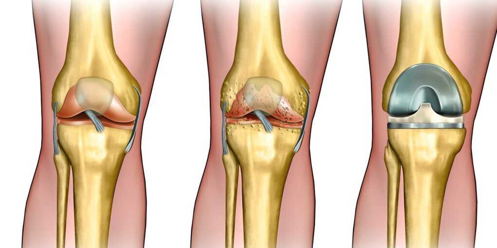 Osteoartrite da articulación do xeonllo