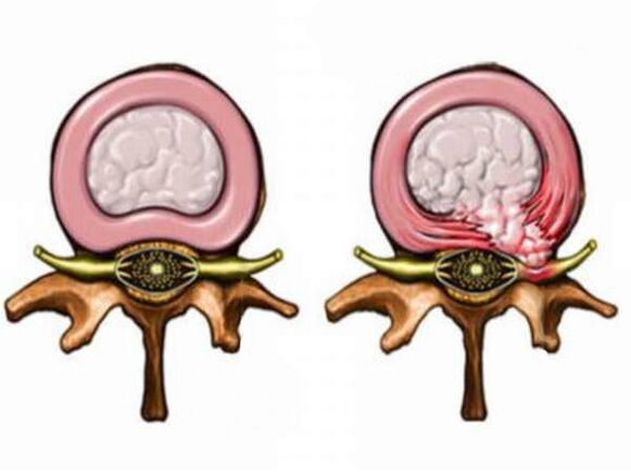 Disco intervertebral saudable e insalubre