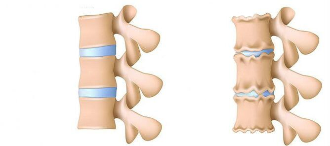Osteocondrose desde o interior